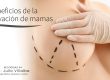 Beneficios de la elevación de mamas