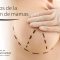 Beneficios de la elevación de mamas
