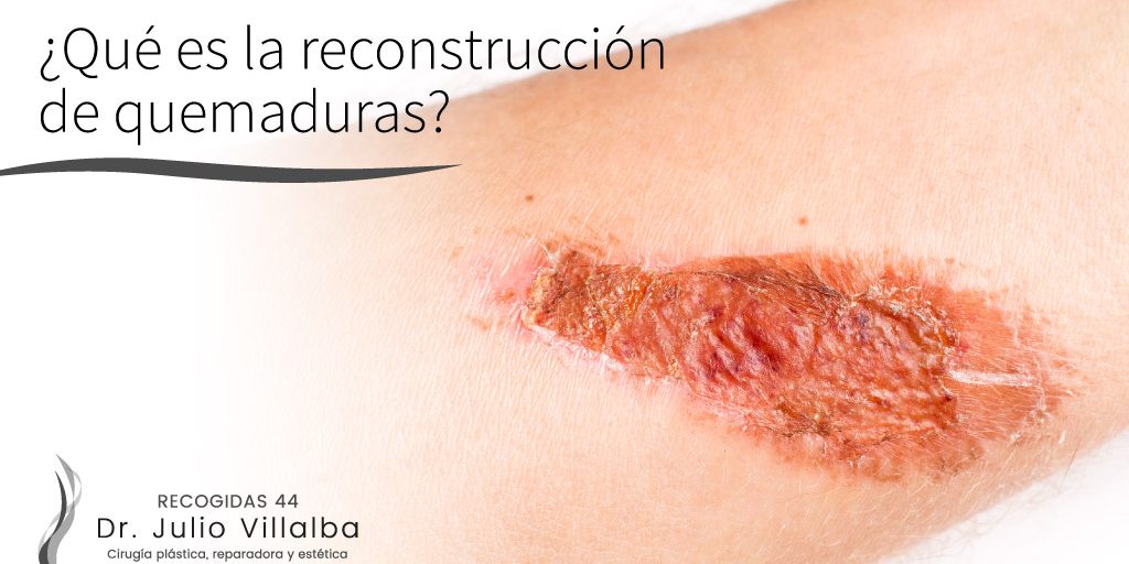 ¿Qué es la reconstrucción de quemaduras?