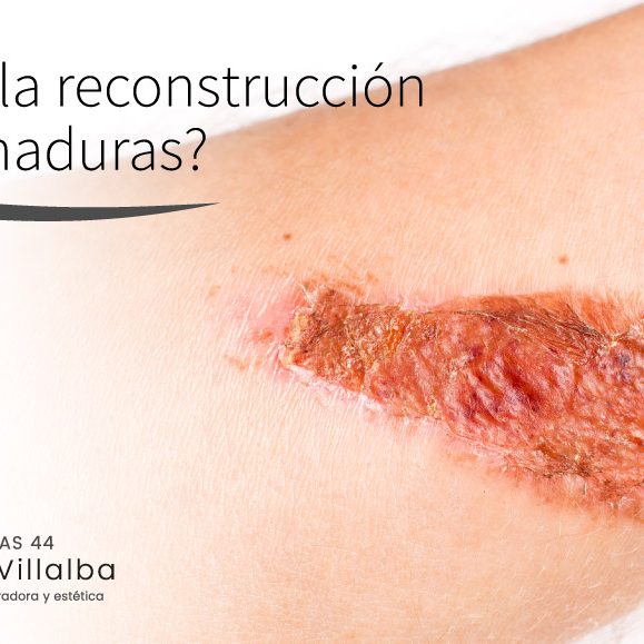 ¿Qué es la reconstrucción de quemaduras? ¿Qué es la reconstrucción de quemaduras?