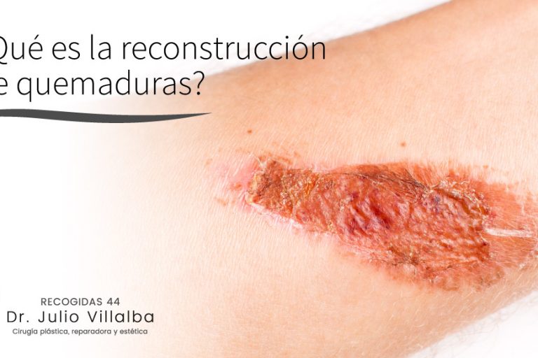 ¿Qué es la reconstrucción de quemaduras?